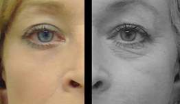 Goz Estetigi Goz Estetigi