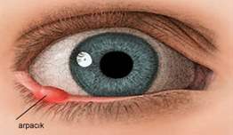 Arpacık ve Şalazyon