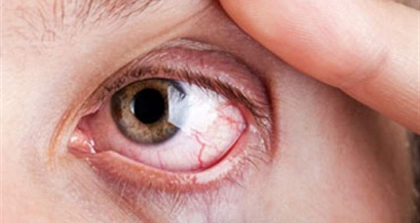 Behcet Hastaligi Levent Optik