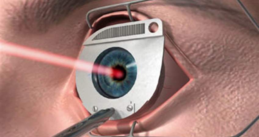 ikinci defa lazer goz tedavisi olunabilir mi