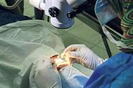Katarakt ameliyatı esnasında oluşabilecek komplikasyonlar