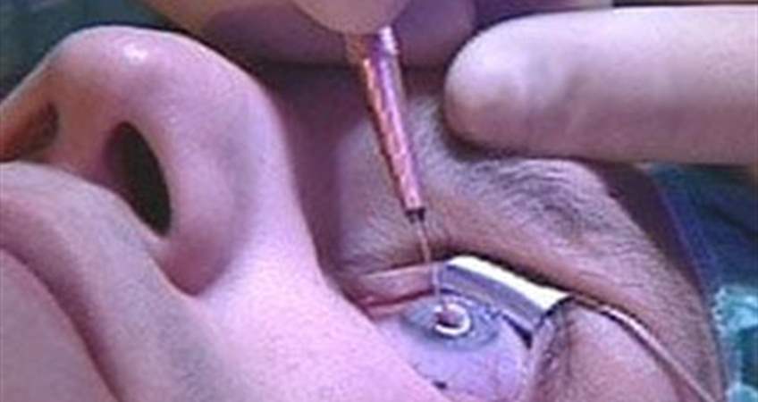 Katarakt Ameliyatı Sırasında