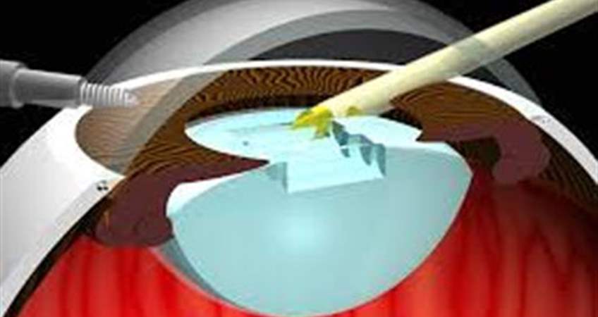 katarakt cerrahisinde fako ameliyati