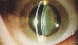 Katarakt Hakkında Bilinen Yanlışlar: Katarakt Gözün Yüzeyini Bulandırır