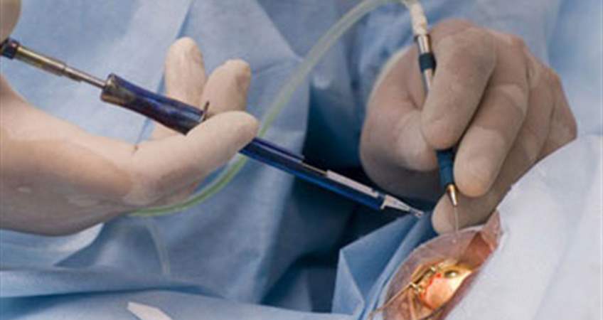 Kataraktı almak için kullanılan cerrahi yöntemler nelerdir?