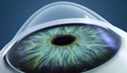 Keratokonus ve Tedavisi