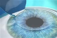 Lasik Göz Tedavisinin Riskleri
