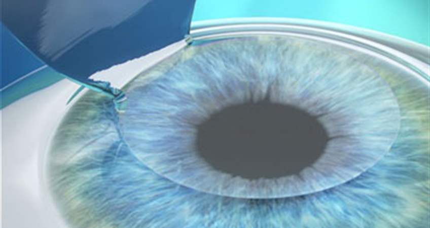 Lasik Göz Tedavisinin Riskleri