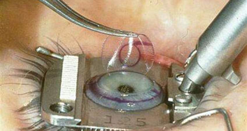 Lasik-PRK (Laser Cerrahisi) Lasik Ameliyatı Sonrası Komplikasyonlar