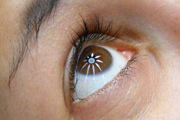 Lasik Tedavisinde Muayane Nasıl Yapılır?