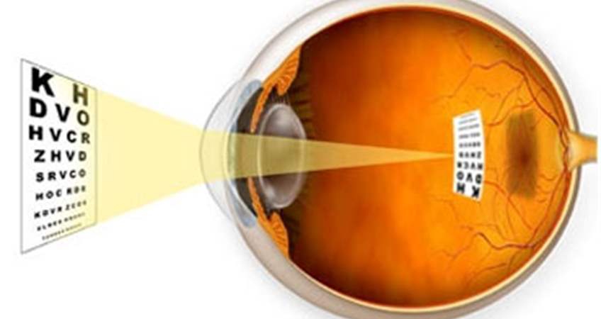 miyop uzagi gorememe nedir