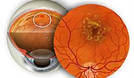 Sarı Nokta Hastalığı