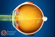 Supracor lazer göz tedavisi kalıcı bir tedavimidir?