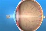 Supracor lazer göz tedavisi nasıl yapılır?