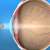 Supracor lazer göz tedavisi nasıl yapılır?