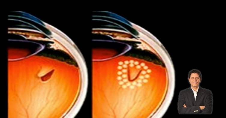 Retina Dekolmanı - Yırtılması Nedir?
