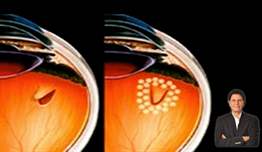Retina Dekolmanı - Yırtılması Nedir?
