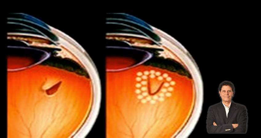 retina dekolmani yirtilmasi nedir