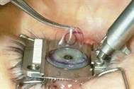 Excimer Lazerle Göz Ameliyatı Nasıl Gerçekleşiyor