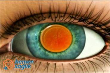 Yağ Lazer Kapsülotomi