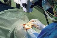 Lazerle göz tedavisi olan kişi katarakt ameliyatı olabilir mi?